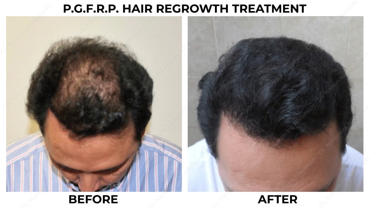114-Dr-Narendra-Nikumbh-Best-Dermatologist-in-Thane-