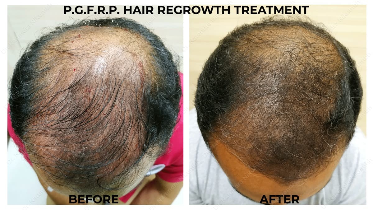 164-Dr-Narendra-Nikumbh-Best-Dermatologist-in-Thane