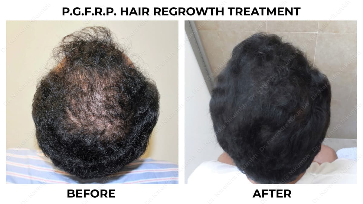 165-Dr-Narendra-Nikumbh-Best-Dermatologist-in-Thane