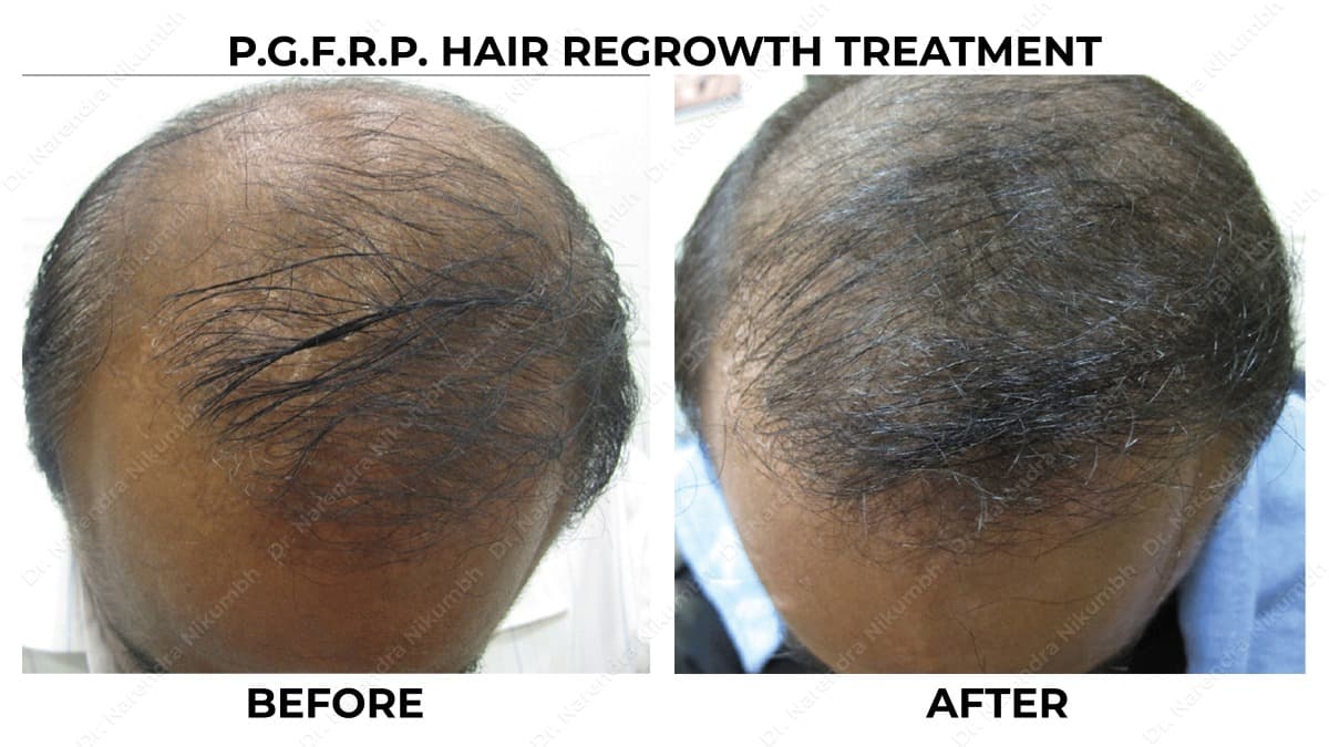 166-Dr-Narendra-Nikumbh-Best-Dermatologist-in-Thane