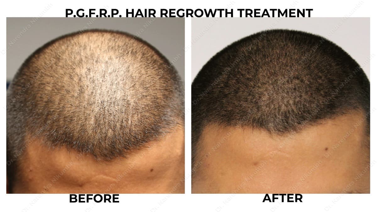 9-Dr-Narendra-Nikumbh-Best-Dermatologist-in-Thane