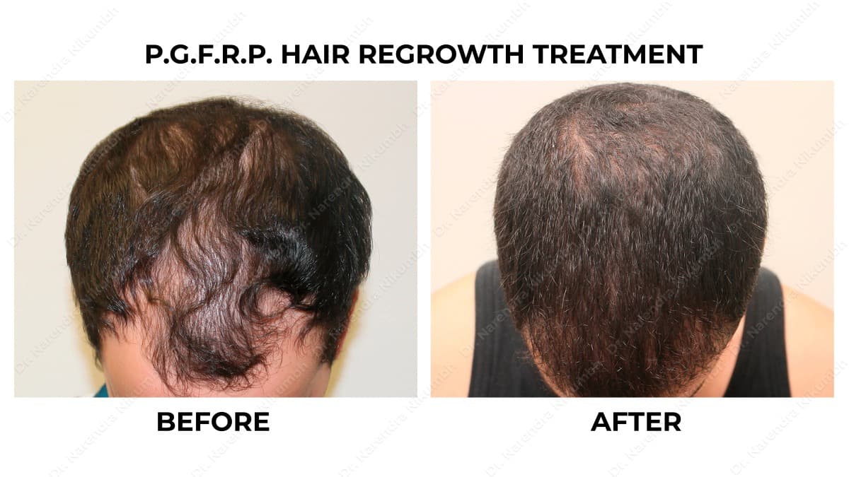 98-Dr-Narendra-Nikumbh-Best-Dermatologist-in-Thane-