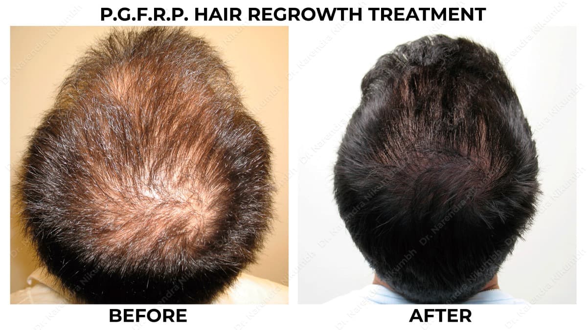 99-Dr-Narendra-Nikumbh-Best-Dermatologist-in-Thane-